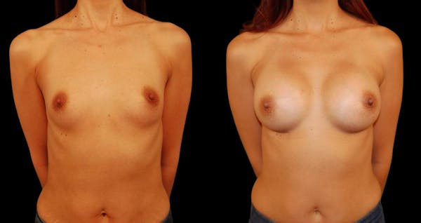 Breast Augmentation Before & After Gallery - Patient 182383 - Image 1