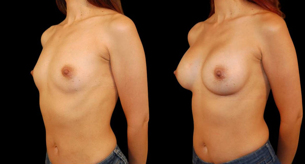 Breast Augmentation Before & After Gallery - Patient 182383 - Image 2