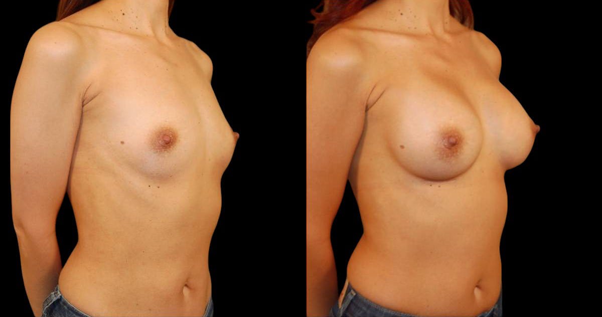 Breast Augmentation Before & After Gallery - Patient 182383 - Image 4