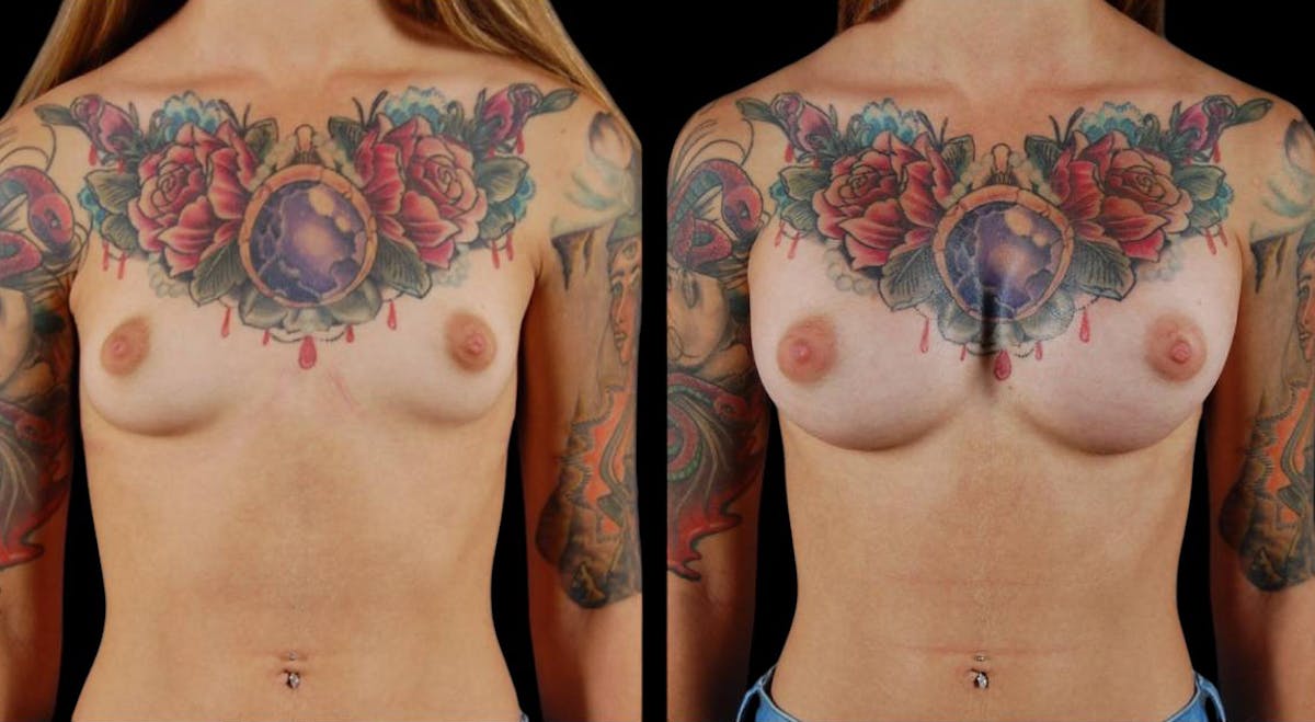 Breast Augmentation Before & After Gallery - Patient 246361 - Image 1