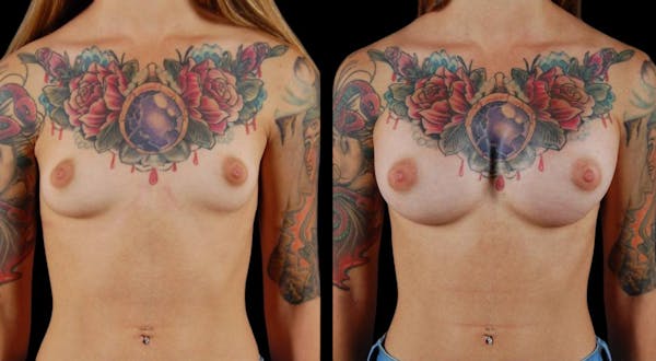 Breast Augmentation Before & After Gallery - Patient 246361 - Image 1