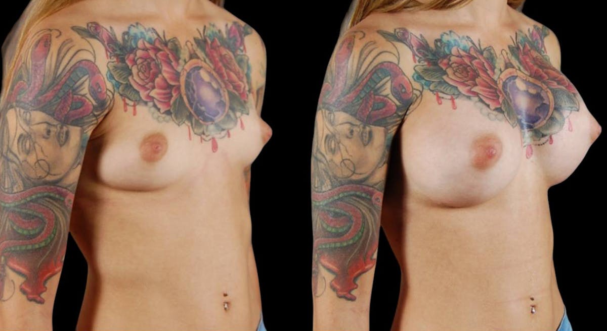 Breast Augmentation Before & After Gallery - Patient 246361 - Image 4