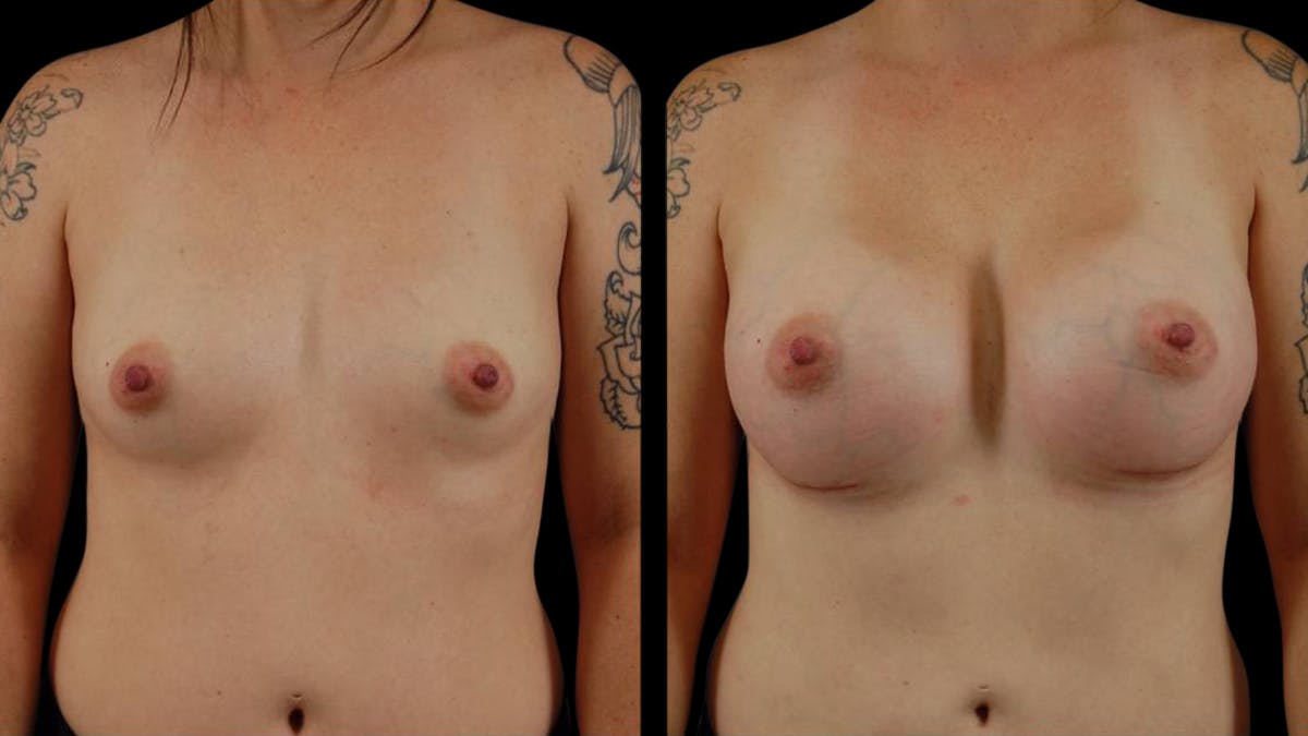 Breast Augmentation Before & After Gallery - Patient 113246 - Image 1
