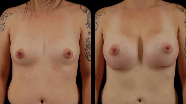 Breast Augmentation Before & After Gallery - Patient 113246 - Image 1