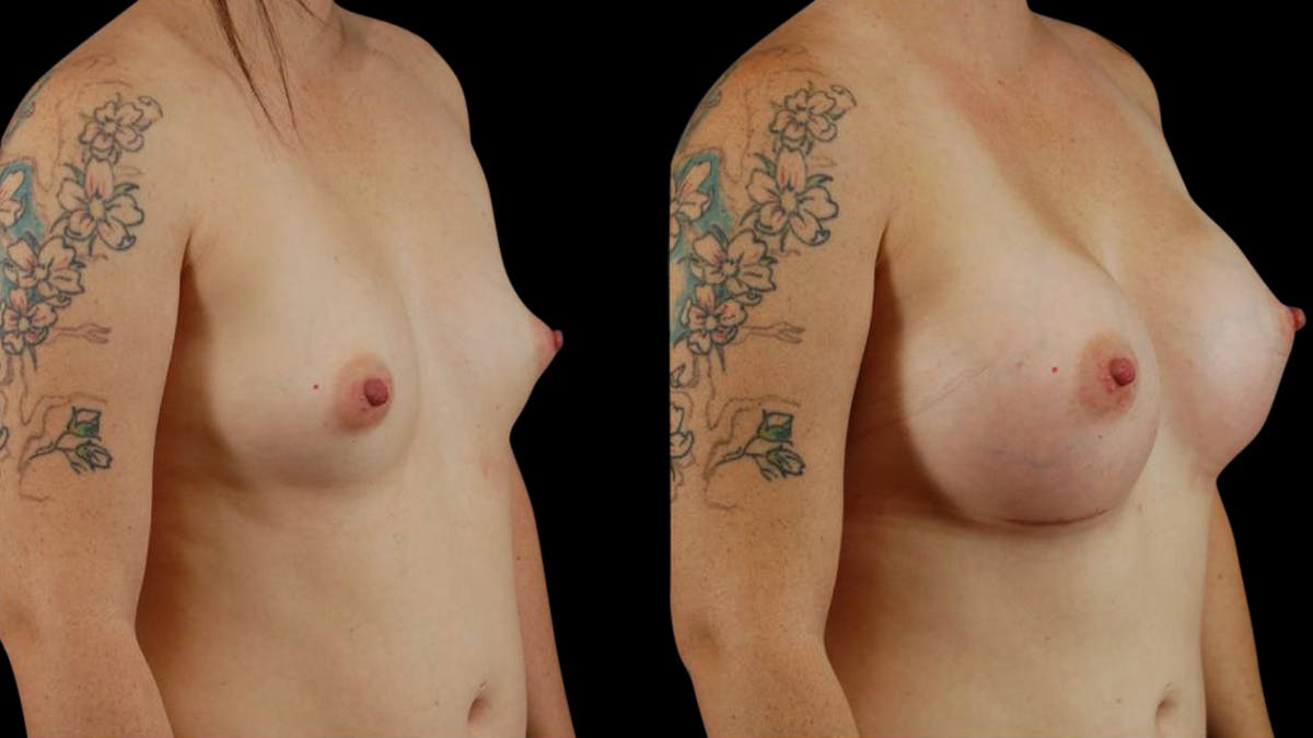 Breast Augmentation Before & After Gallery - Patient 113246 - Image 2