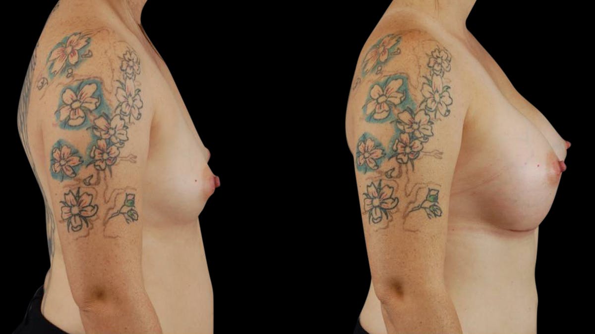 Breast Augmentation Before & After Gallery - Patient 113246 - Image 3