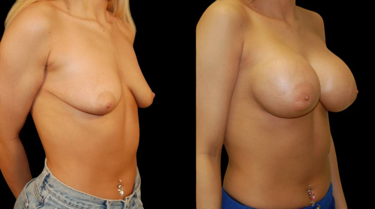 Breast Augmentation Before & After Gallery - Patient 280354 - Image 2