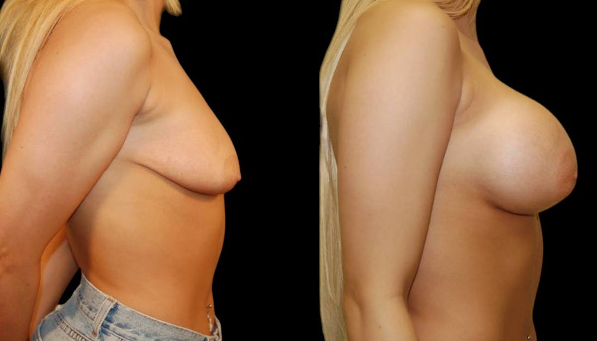 Breast Augmentation Before & After Gallery - Patient 280354 - Image 3
