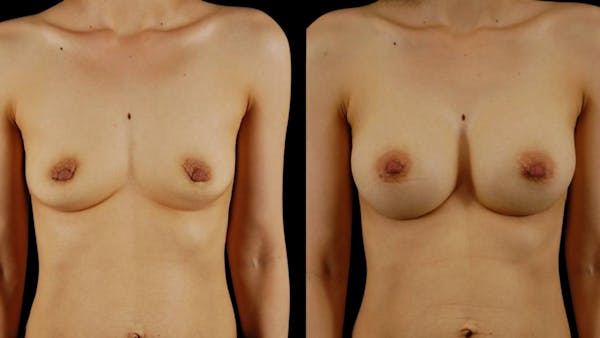 Breast Augmentation Before & After Gallery - Patient 304120 - Image 1