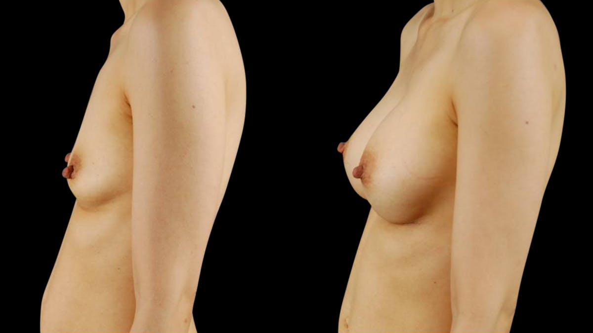 Breast Augmentation Before & After Gallery - Patient 304120 - Image 3