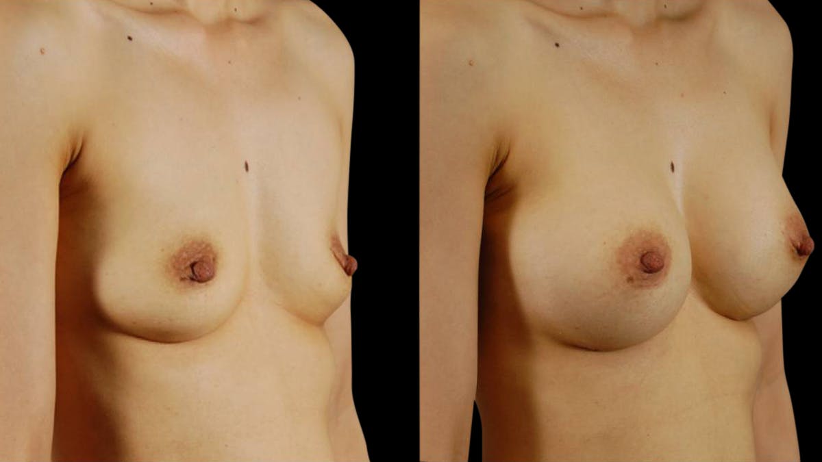 Breast Augmentation Before & After Gallery - Patient 304120 - Image 4