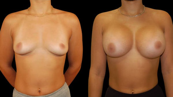 Breast Augmentation Before & After Gallery - Patient 234980 - Image 1