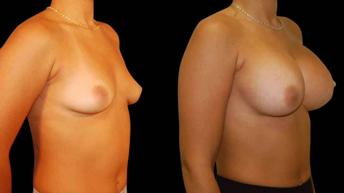 Breast Augmentation Before & After Gallery - Patient 234980 - Image 2