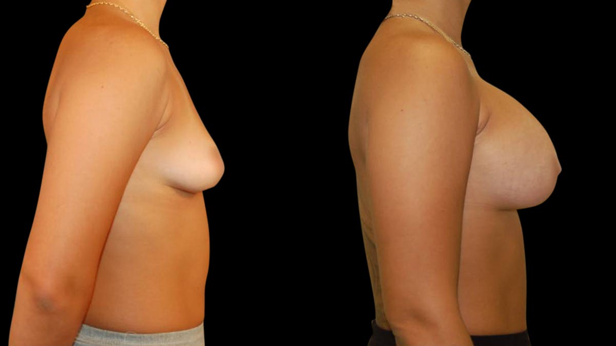 Breast Augmentation Before & After Gallery - Patient 234980 - Image 3