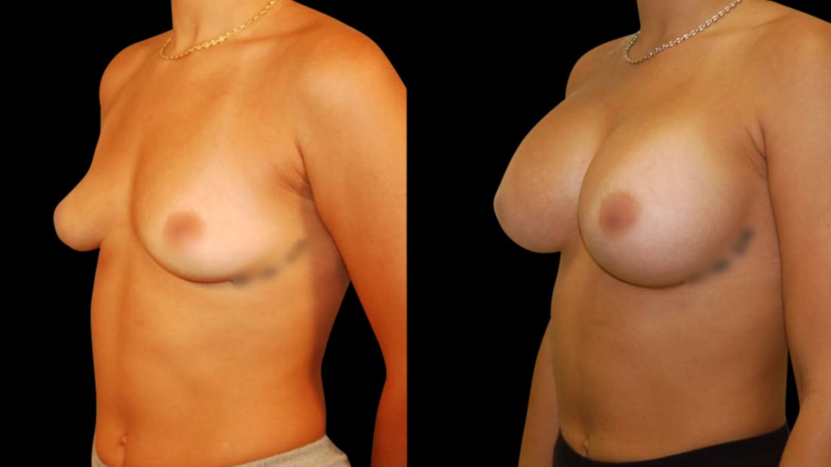 Breast Augmentation Before & After Gallery - Patient 234980 - Image 4