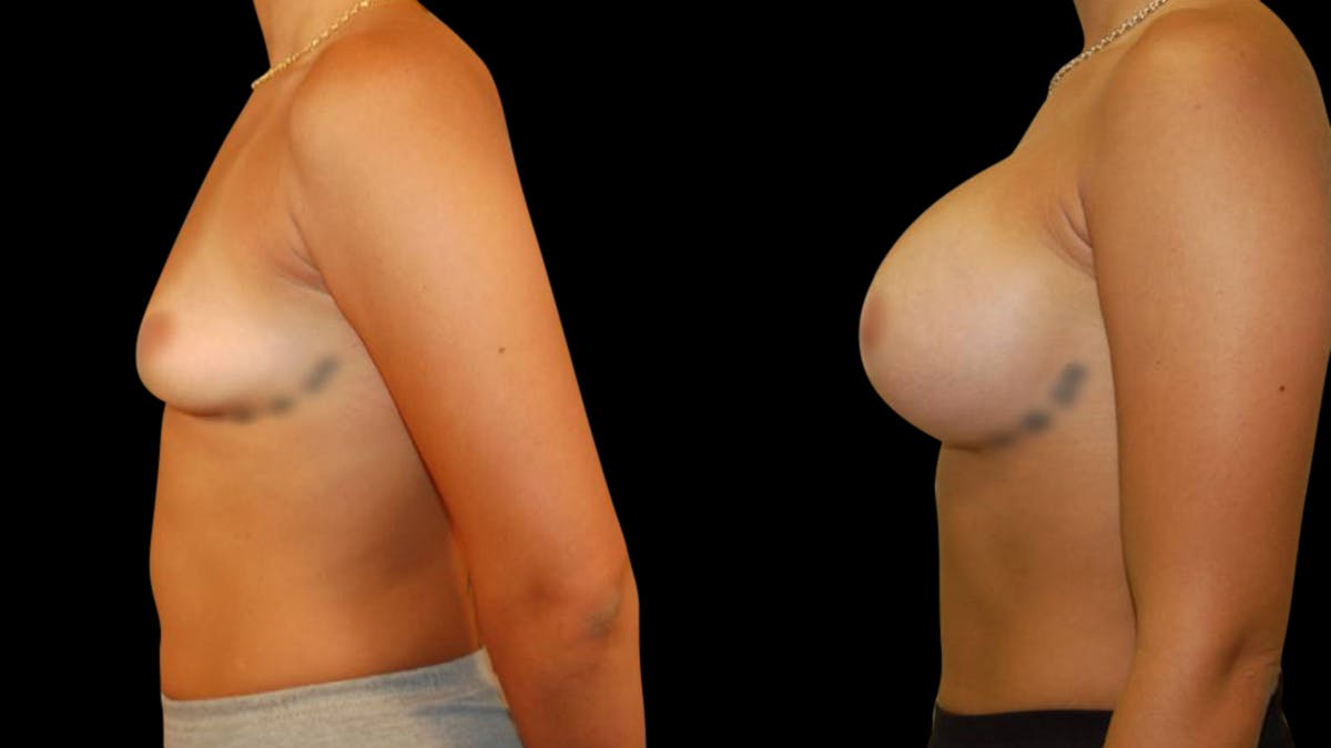 Breast Augmentation Before & After Gallery - Patient 234980 - Image 5