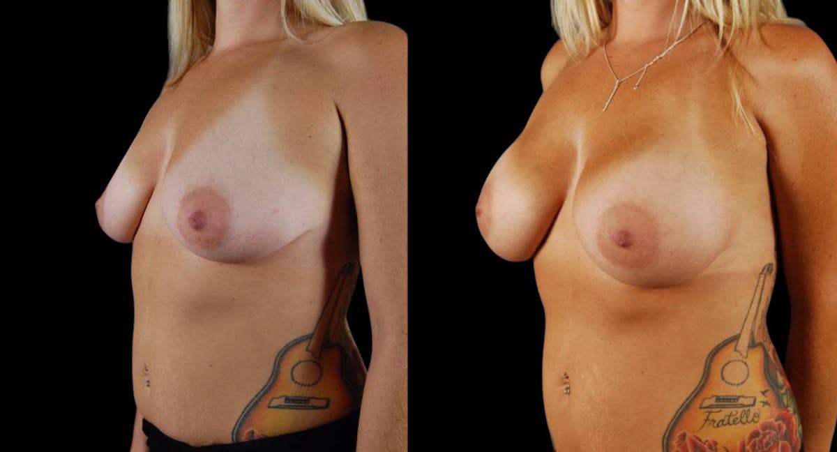 Breast Augmentation Before & After Gallery - Patient 308470 - Image 4