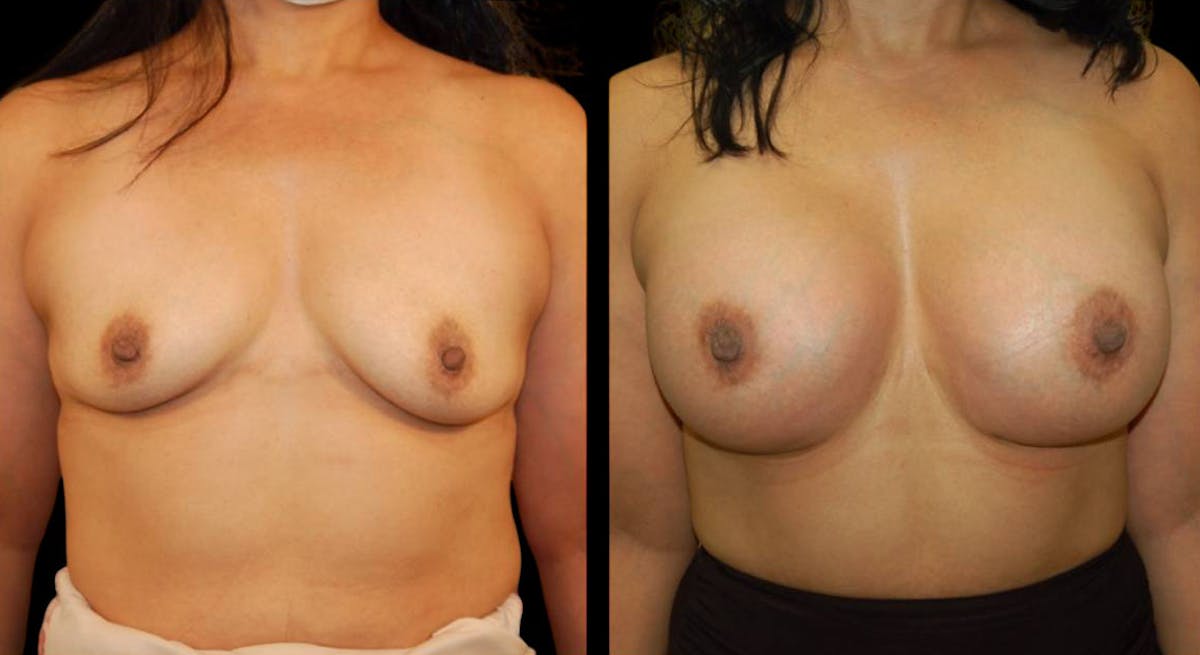 Breast Augmentation Before & After Gallery - Patient 137306 - Image 1
