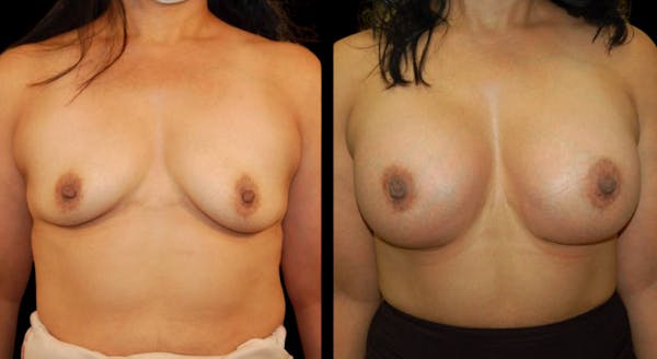 Breast Augmentation Before & After Gallery - Patient 137306 - Image 1