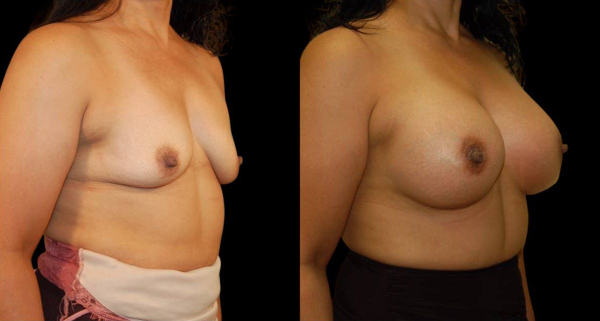 Breast Augmentation Before & After Gallery - Patient 137306 - Image 2