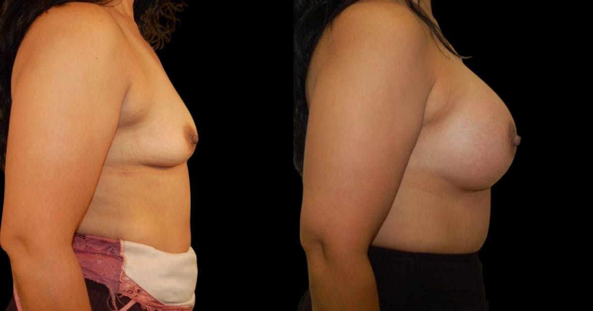 Breast Augmentation Before & After Gallery - Patient 137306 - Image 3
