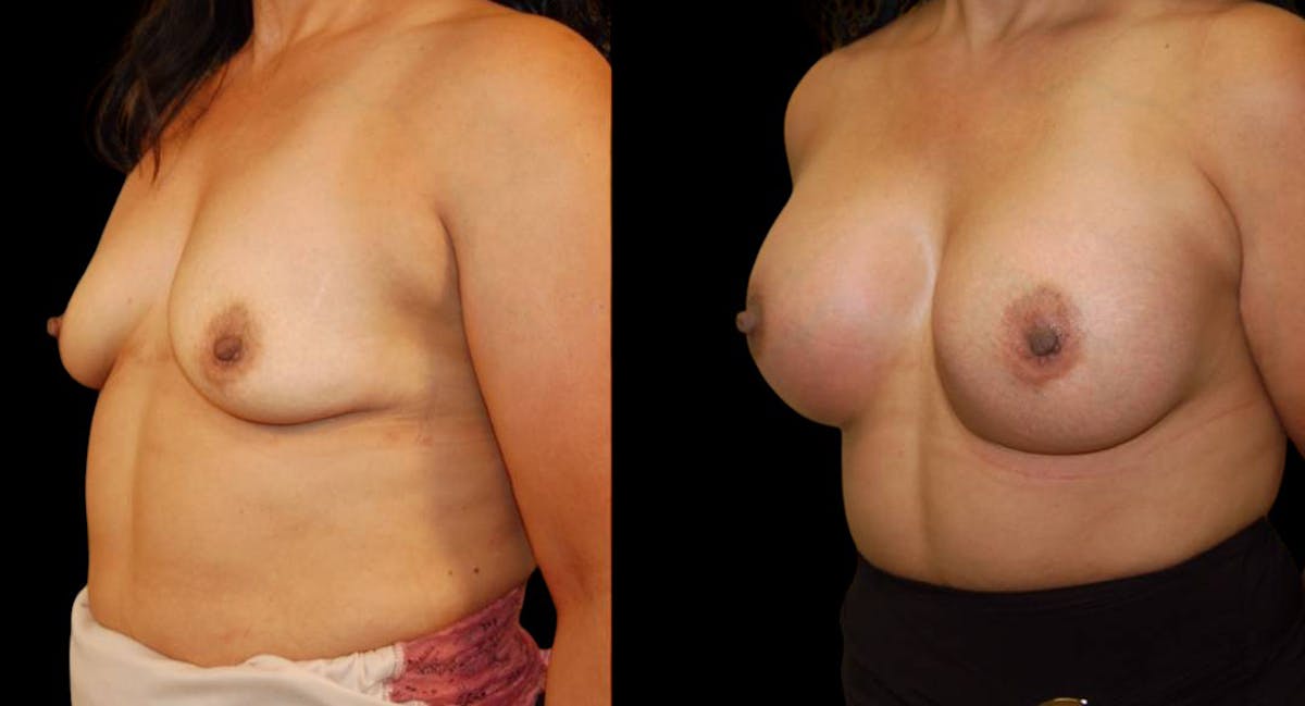 Breast Augmentation Before & After Gallery - Patient 137306 - Image 4