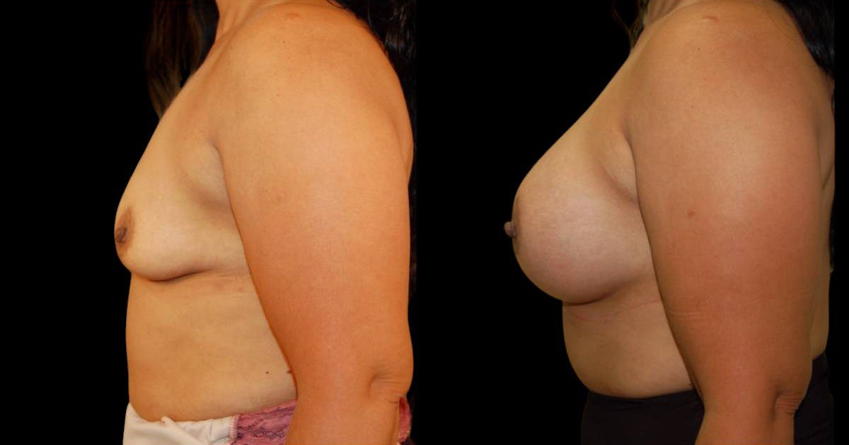 Breast Augmentation Before & After Gallery - Patient 137306 - Image 5