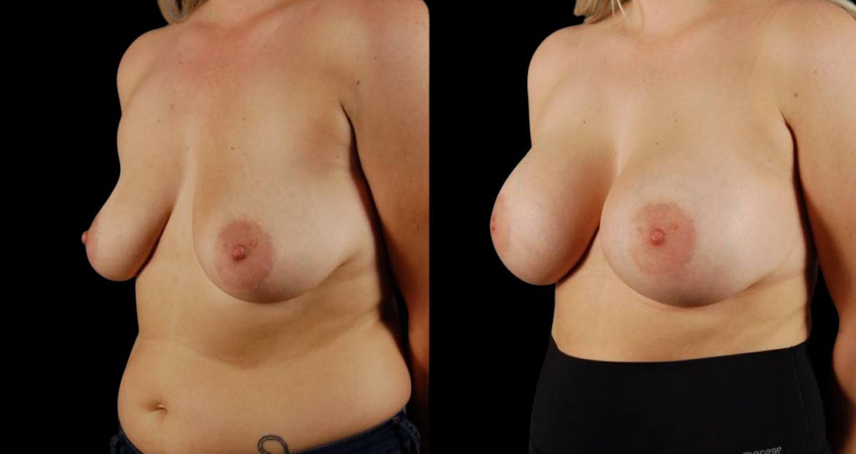 Breast Augmentation Before & After Gallery - Patient 168977 - Image 2
