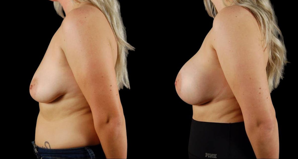 Breast Augmentation Before & After Gallery - Patient 168977 - Image 3