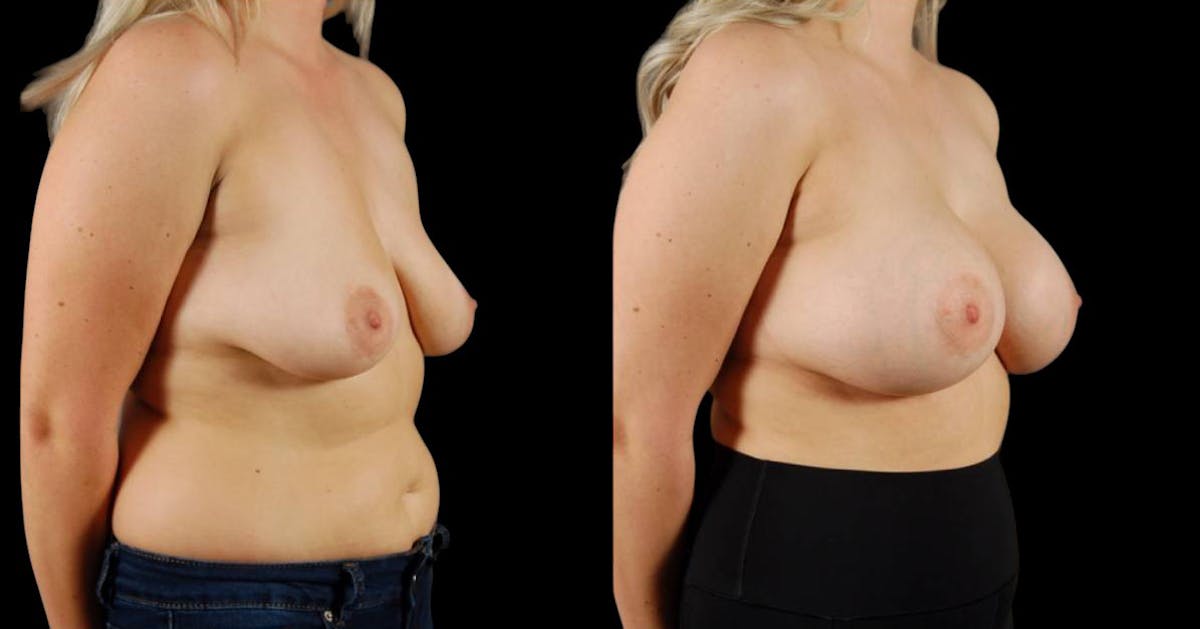 Breast Augmentation Before & After Gallery - Patient 168977 - Image 1