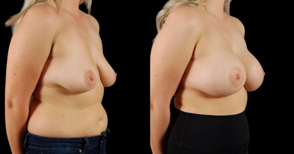 Breast Augmentation Before & After Gallery - Patient 168977 - Image 1