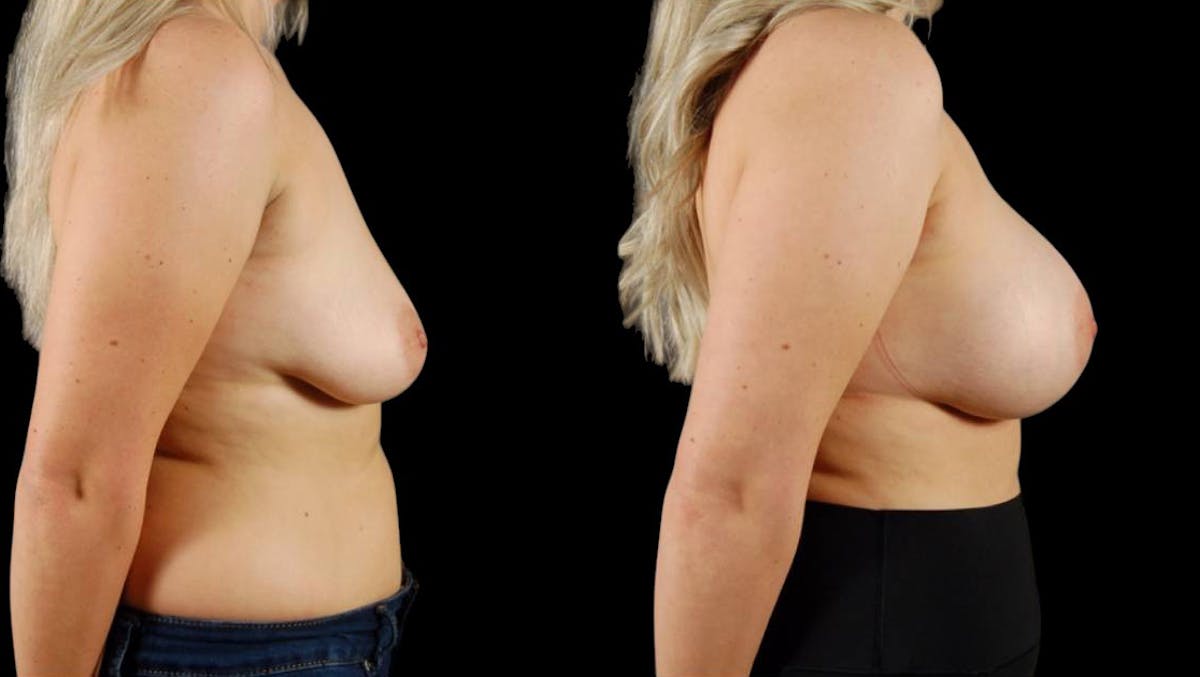 Breast Augmentation Before & After Gallery - Patient 168977 - Image 4