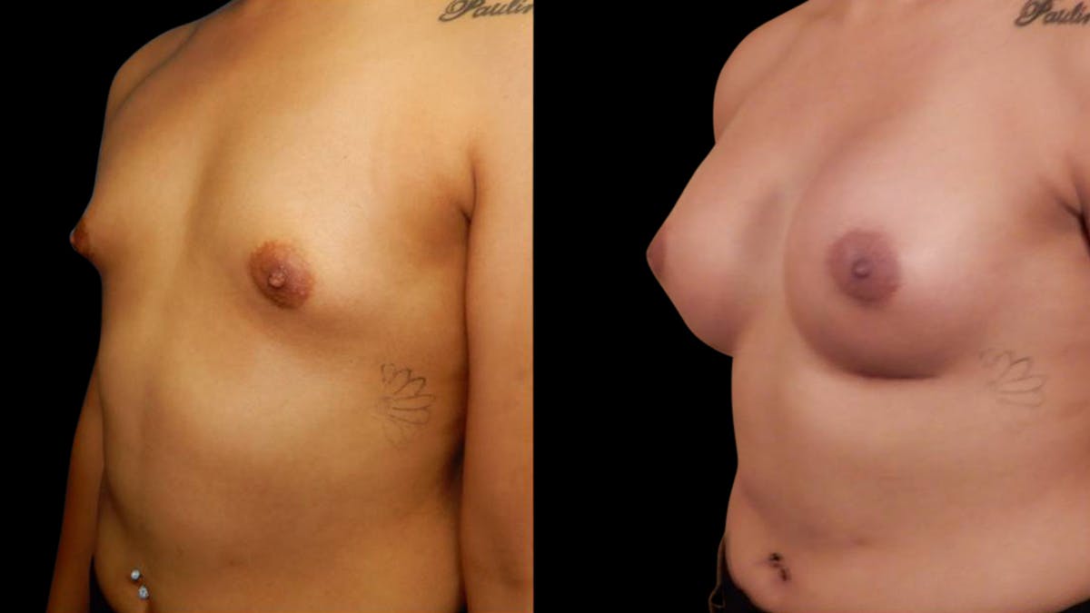 Breast Augmentation Before & After Gallery - Patient 636714 - Image 3