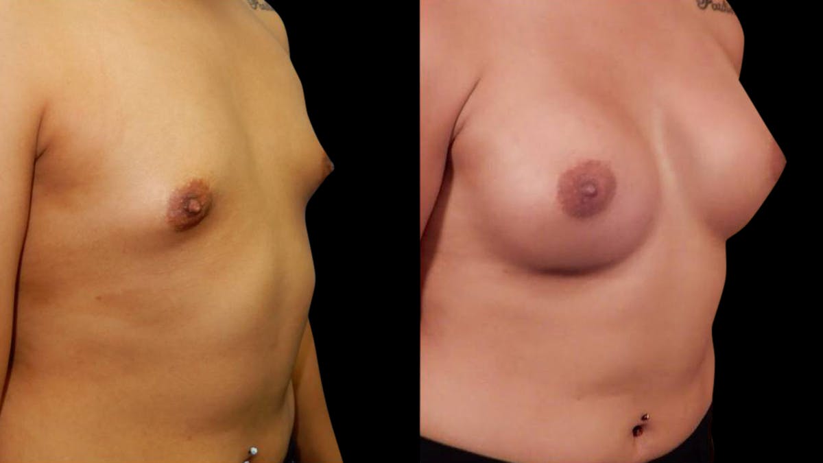 Breast Augmentation Before & After Gallery - Patient 636714 - Image 2