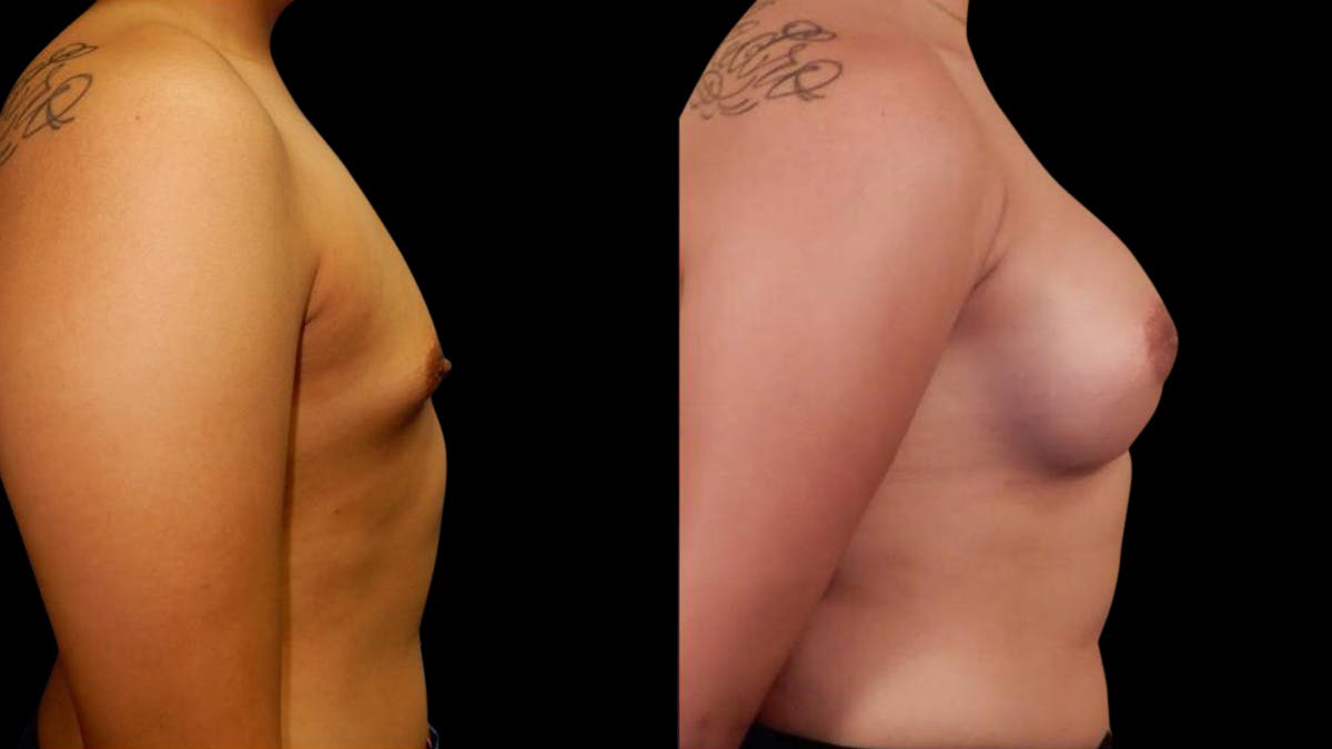 Breast Augmentation Before & After Gallery - Patient 636714 - Image 4