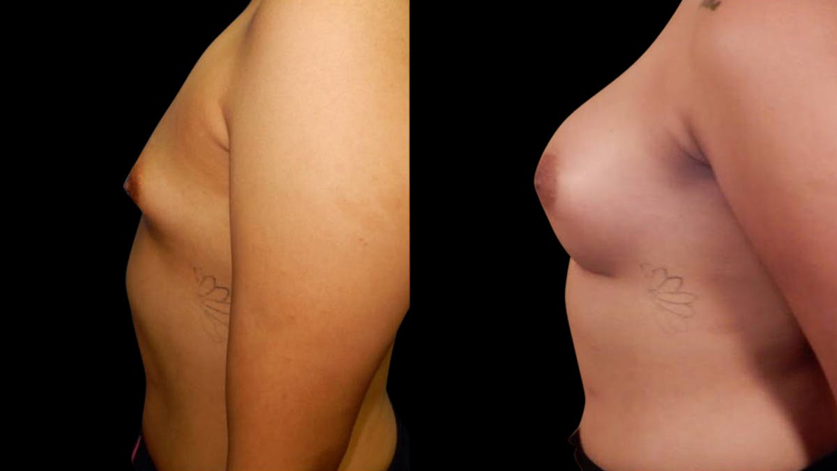 Breast Augmentation Before & After Gallery - Patient 636714 - Image 5