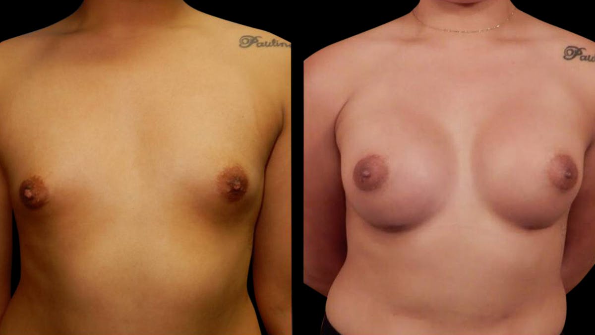 Breast Augmentation Before & After Gallery - Patient 636714 - Image 1