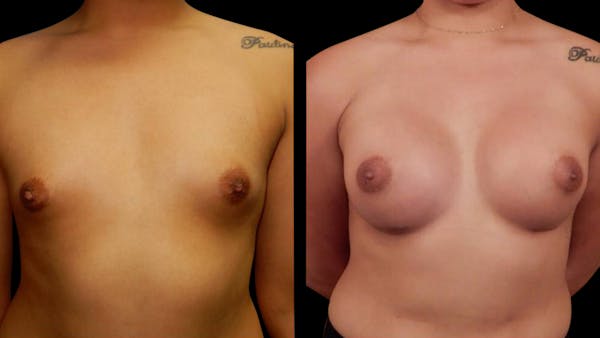 Breast Augmentation Before & After Gallery - Patient 636714 - Image 1
