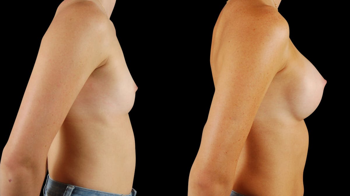 Breast Augmentation Before & After Gallery - Patient 341867 - Image 3