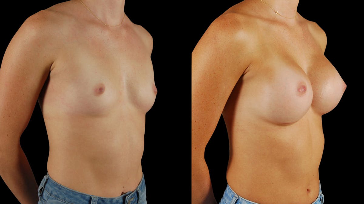 Breast Augmentation Before & After Gallery - Patient 341867 - Image 2