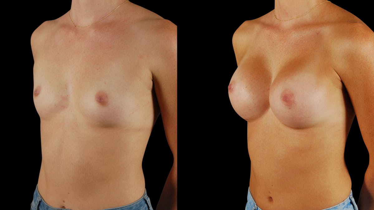 Breast Augmentation Before & After Gallery - Patient 341867 - Image 4