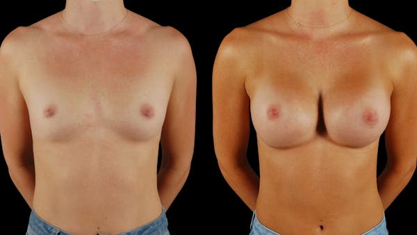 Breast Augmentation Before & After Gallery - Patient 341867 - Image 1