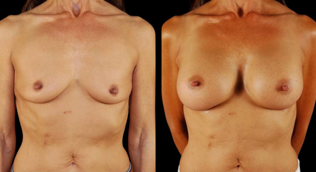 Breast Augmentation Before & After Gallery - Patient 328323 - Image 1