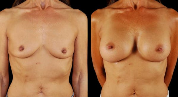 Breast Augmentation Before & After Gallery - Patient 328323 - Image 1