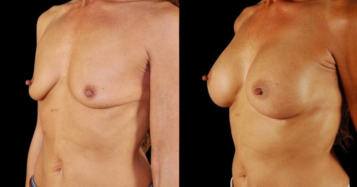 Breast Augmentation Before & After Gallery - Patient 328323 - Image 2