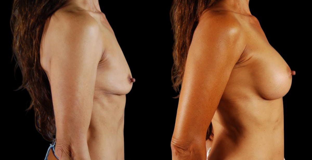 Breast Augmentation Before & After Gallery - Patient 328323 - Image 4