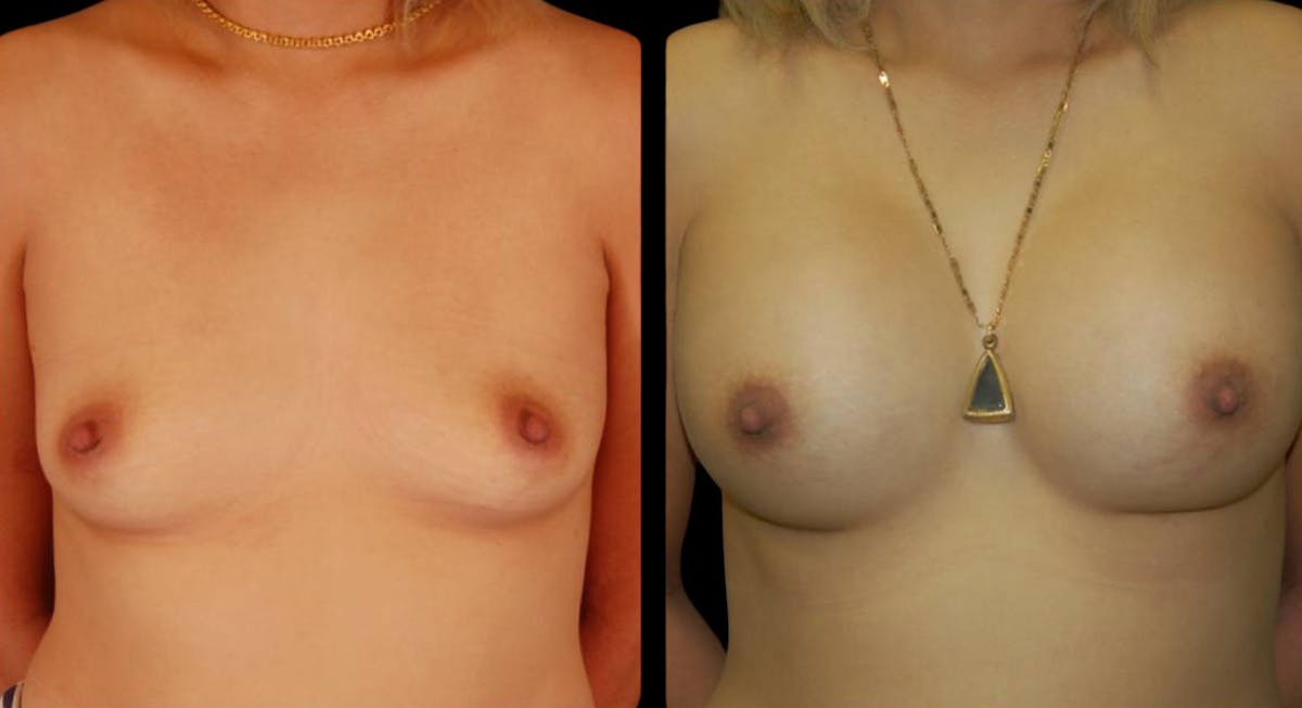 Breast Augmentation Before & After Gallery - Patient 204402 - Image 1