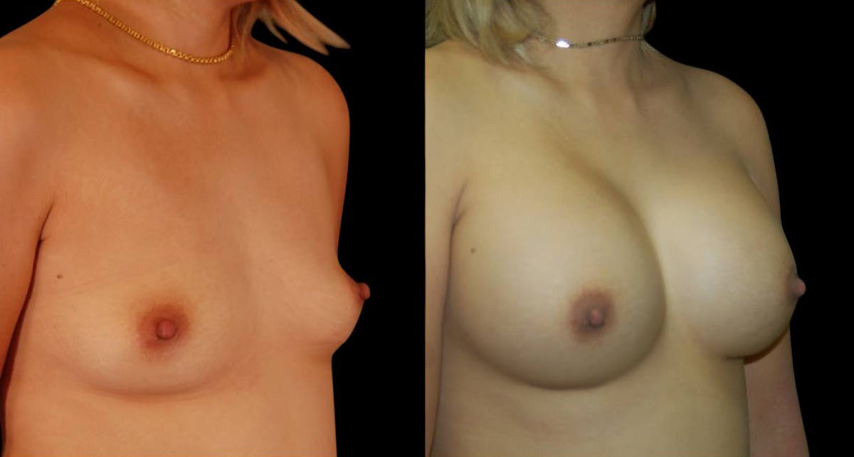 Breast Augmentation Before & After Gallery - Patient 204402 - Image 2