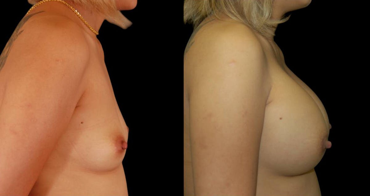 Breast Augmentation Before & After Gallery - Patient 204402 - Image 3