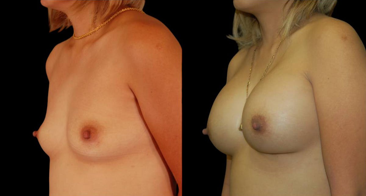 Breast Augmentation Before & After Gallery - Patient 204402 - Image 4
